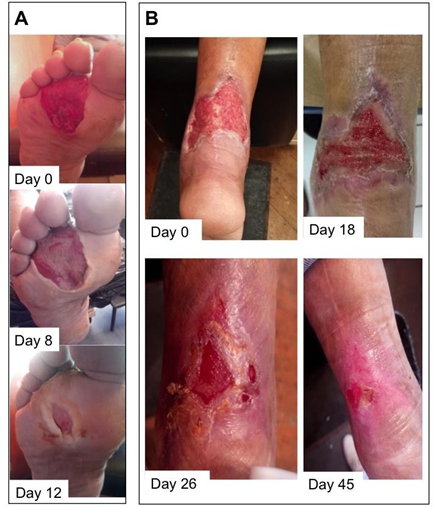 Chronological evolution of the lesion of diabetic foot ulcers classified as Wagner grade II, treated with topical administration of AgNPs. DFU from (A) 46 years-old male patient with type-2 diabetes and (B) 40 years-old male patient with type-2 diabetes. In both figures (A and B) initial appearance of the ulcer is shown and the evolution of the DFU after several days of treatment with AgNPs solution.